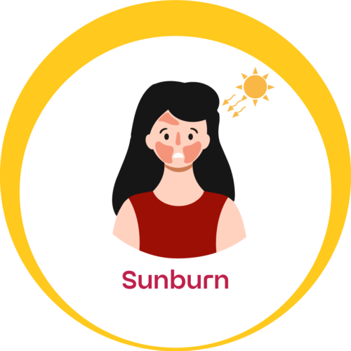 Sunburn